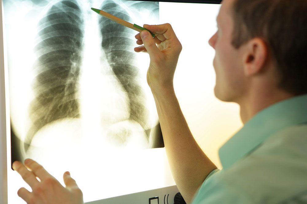 MAC lung disease – 8 common signs and management options